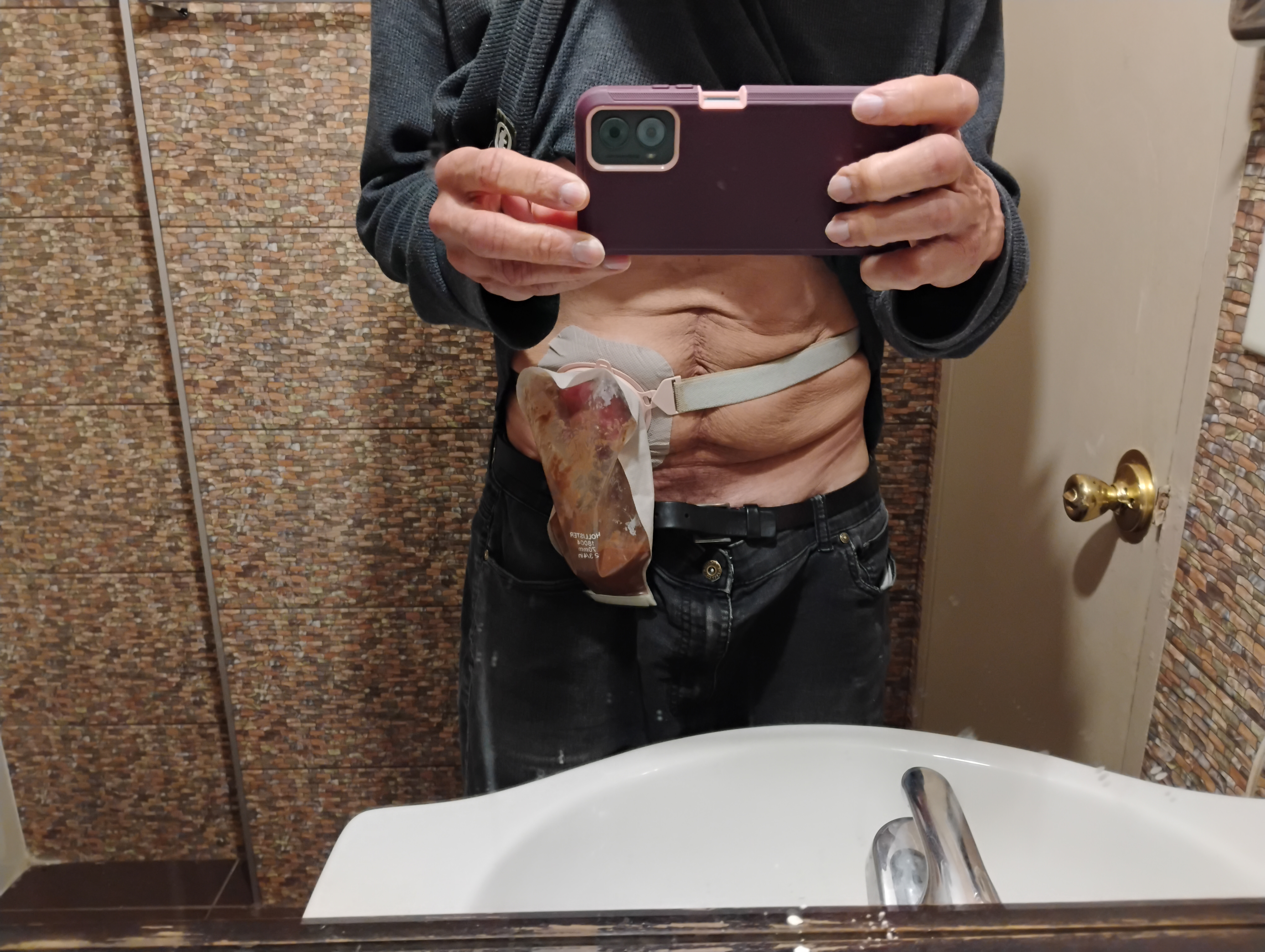 Symptoms of a Prolapsed Stoma